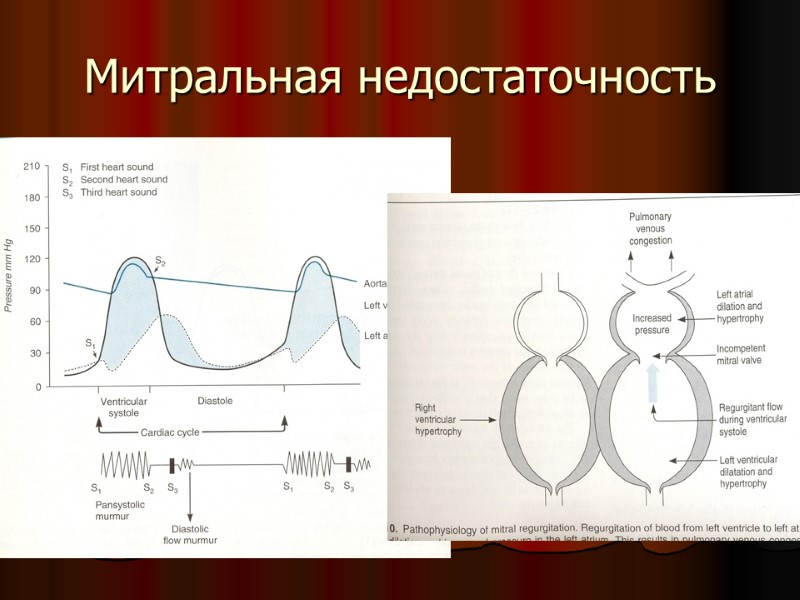 Митральная недостаточность